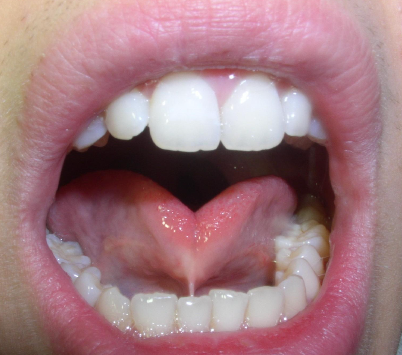 About Myofunctional Therapy